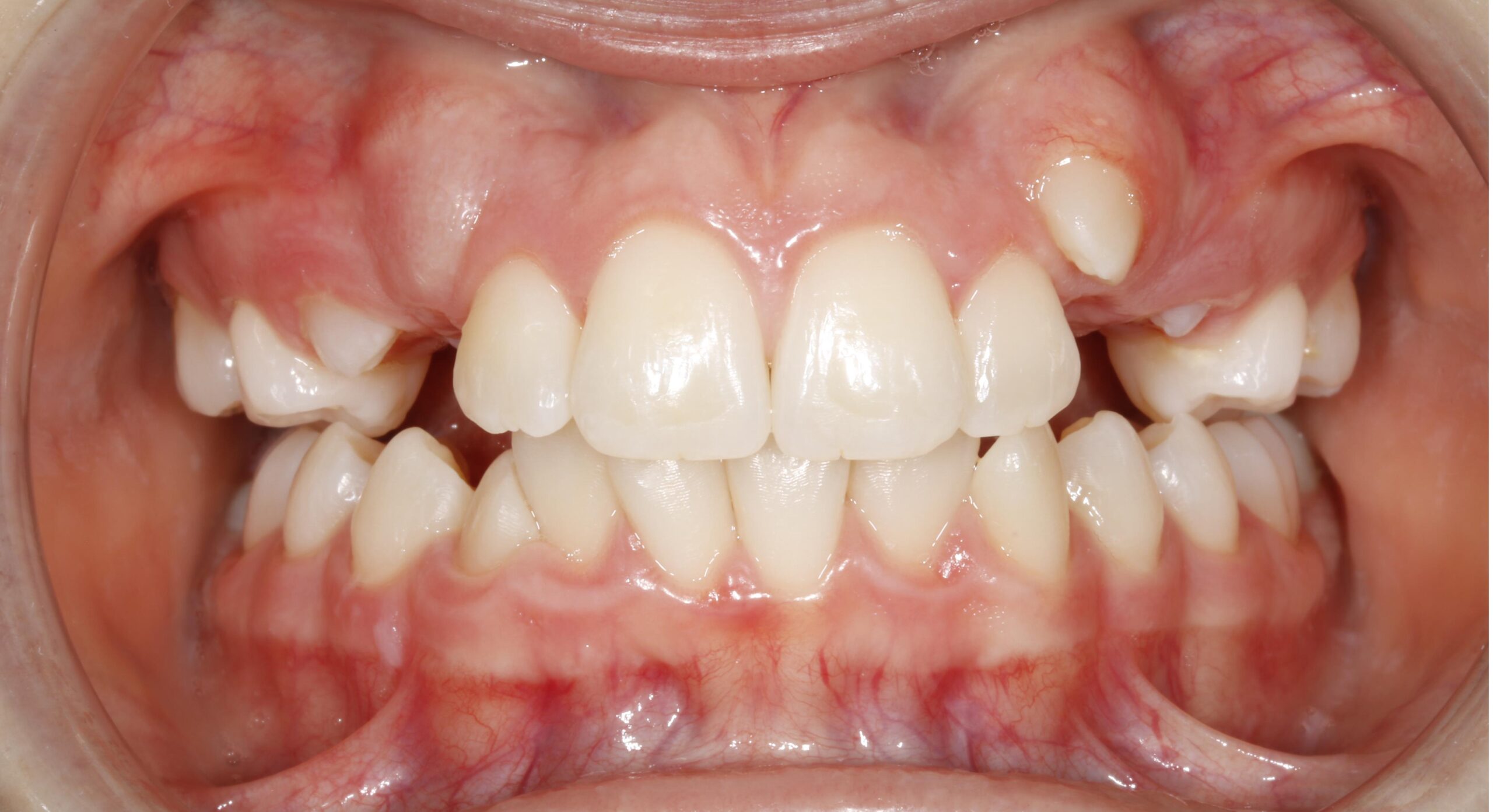 Orthodontic-Case treatment Before