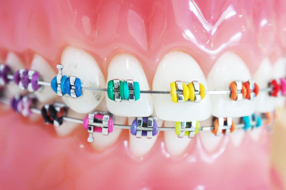 Multi color of orthodontic bracket or brace