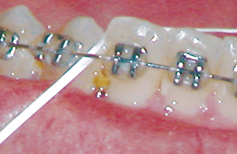 Food caught Between Teeth