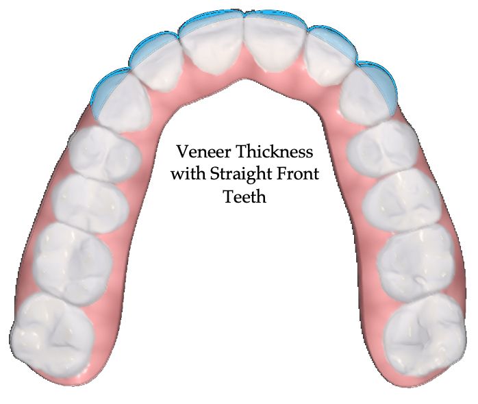 Veneer Thickness Without Ortho