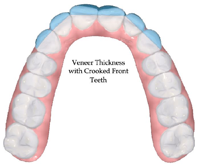 Veneer Thickness With crooked front teeth