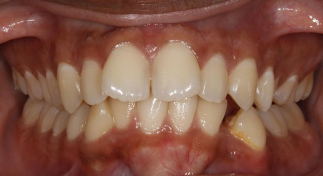 Orthodontic-Case Before