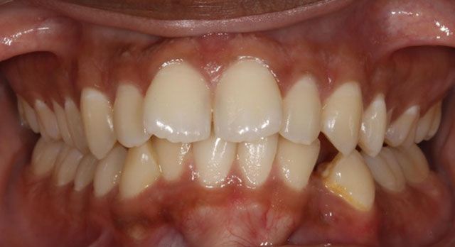 Orthodontic-Case Before