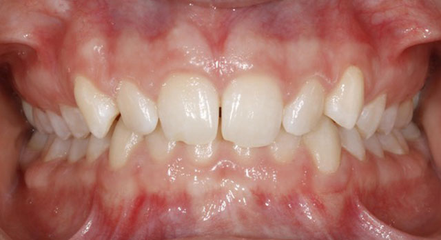 Orthodontic-Case treatment Before