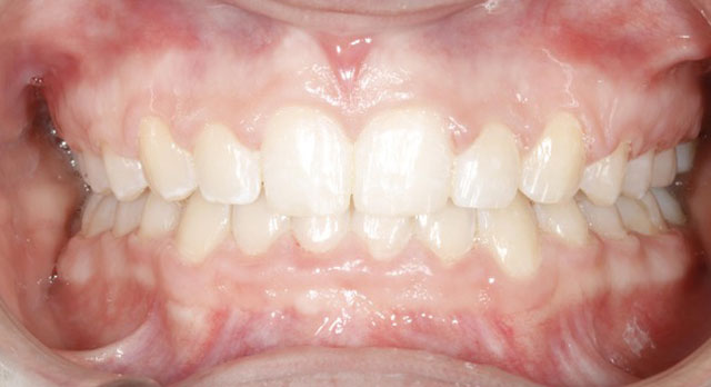 Orthodontic-Case After