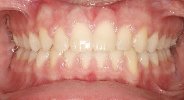 Orthodontic-Case treatment After