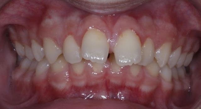 Orthodontic-Case treatment Before