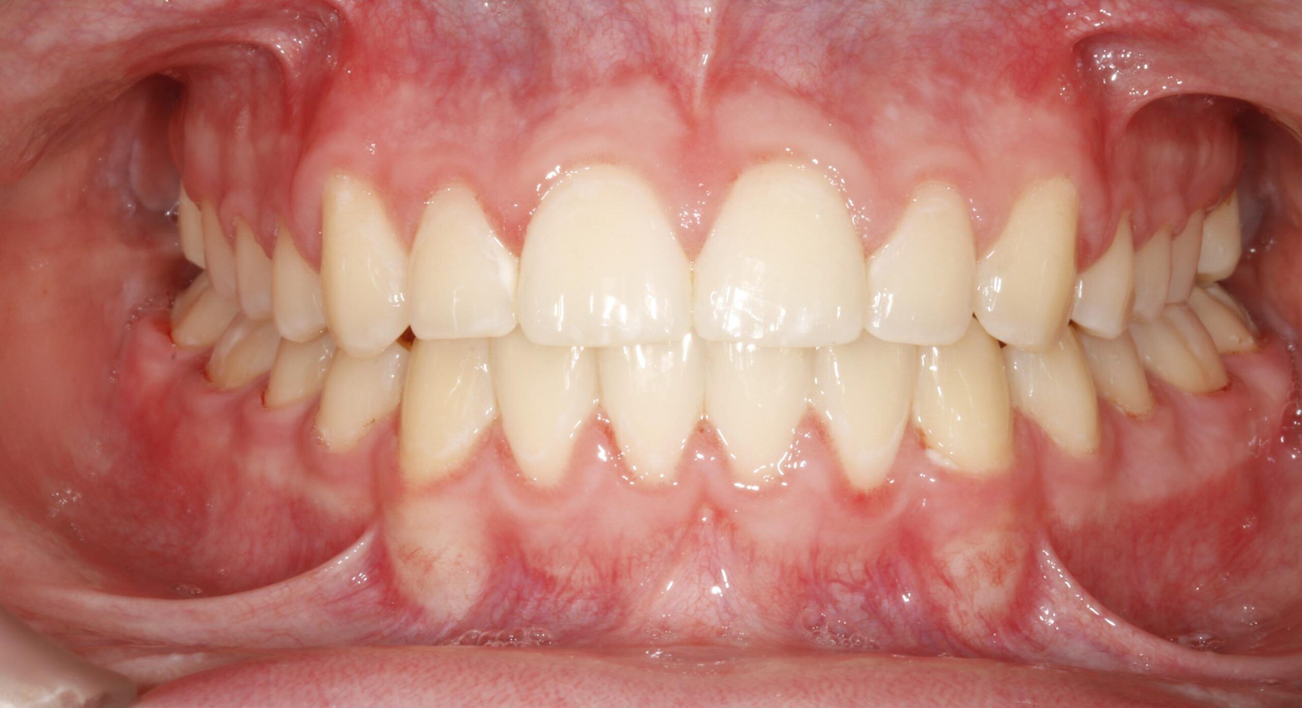 Orthodontic-Case treatment After