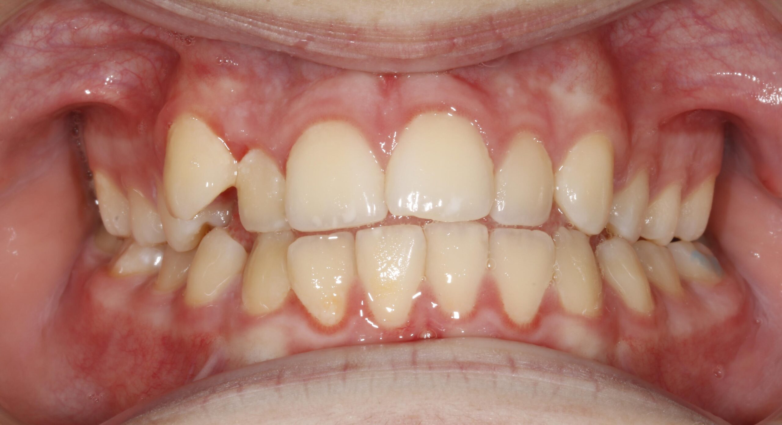 Orthodontic-Case treatment Before