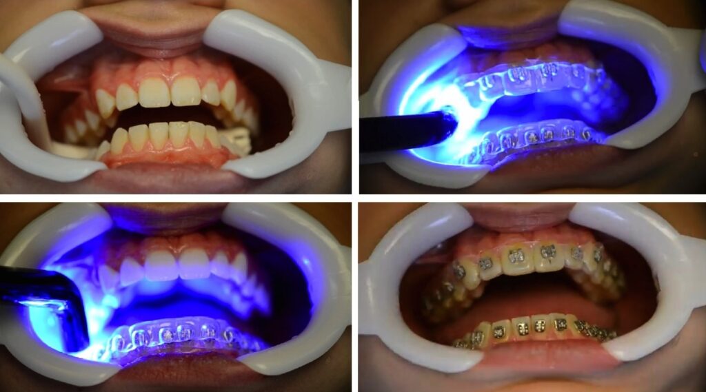 3D Intraoral Scanning