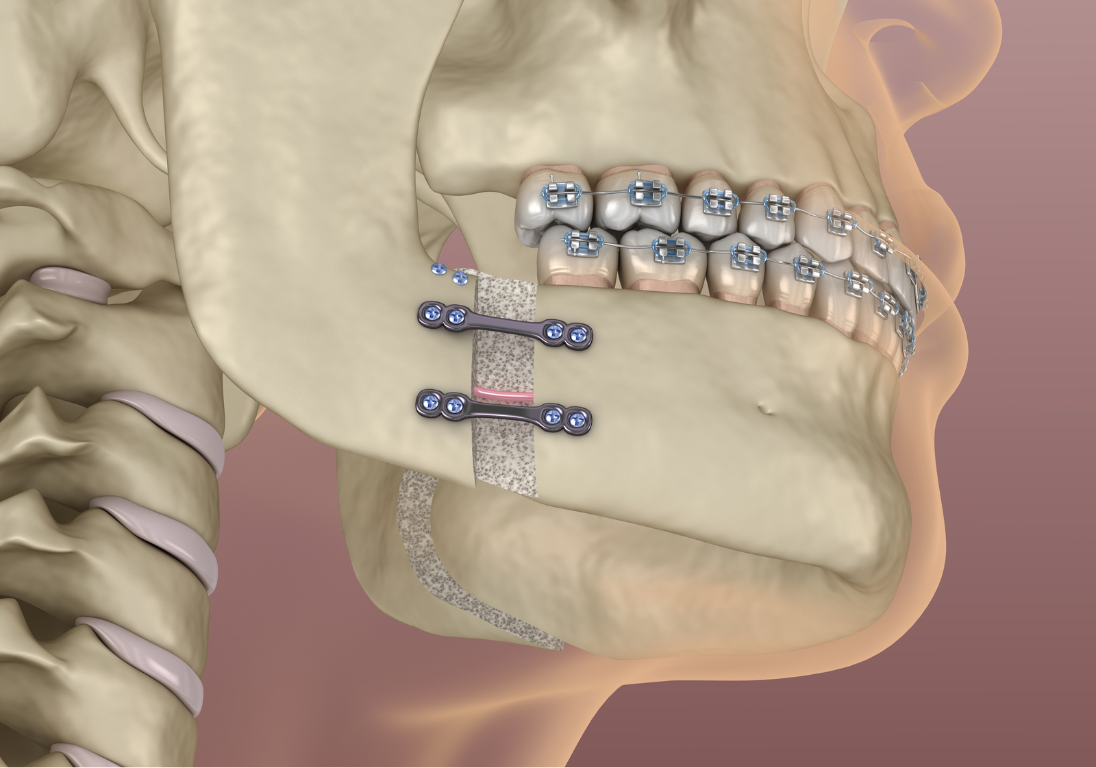 Mandibular Advancement surgery