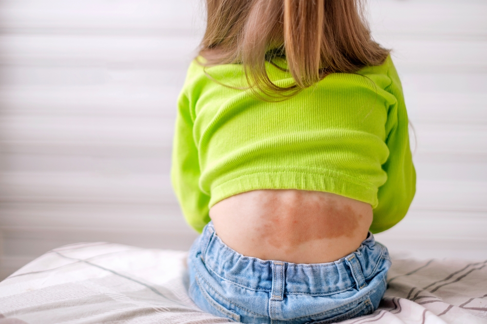 Large red-brown spot on lower back of child from birth.