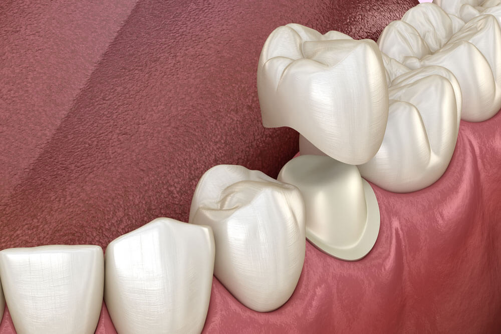 Preparated premolar tooth and dental metal-ceramic crown.