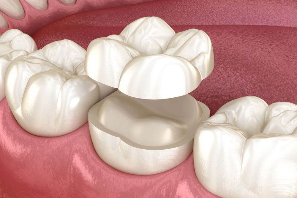 Onlay ceramic crown fixation over tooth