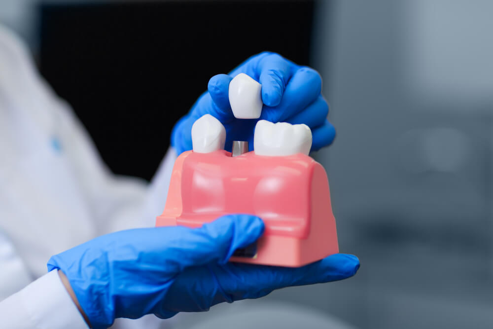 Real doctor holding model of teeth with dental implant, closeup