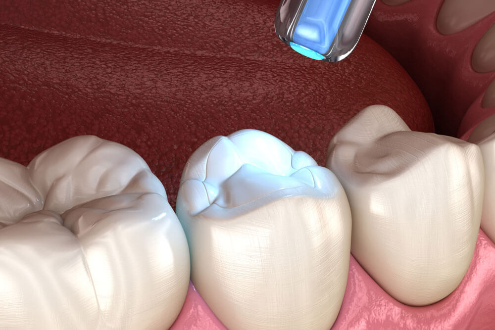 Tooth restoration with filling and polymerization lamp. Medically accurate tooth 3D illustration.