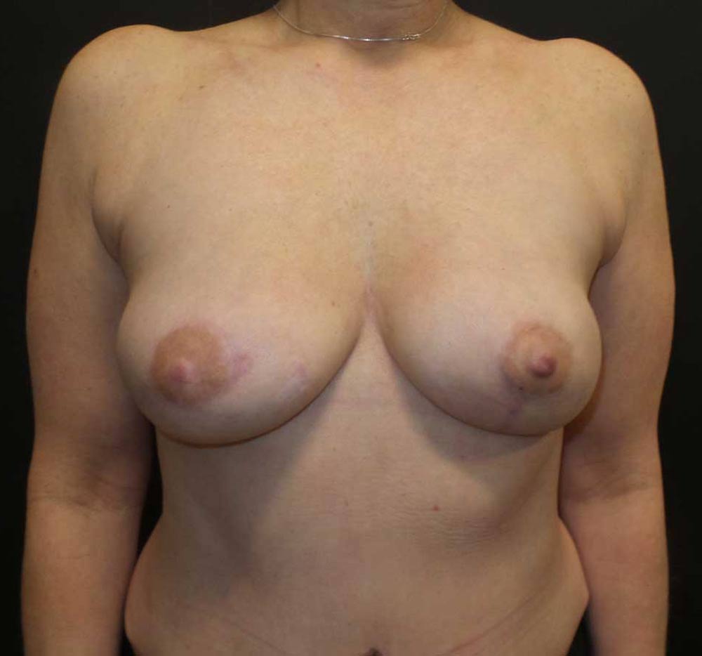 Bilateral DIEP Flaps - Patient After Treatment