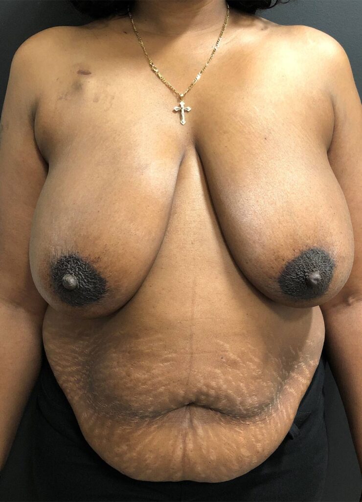 Bilateral DIEP Flaps - Patient Before Treatment