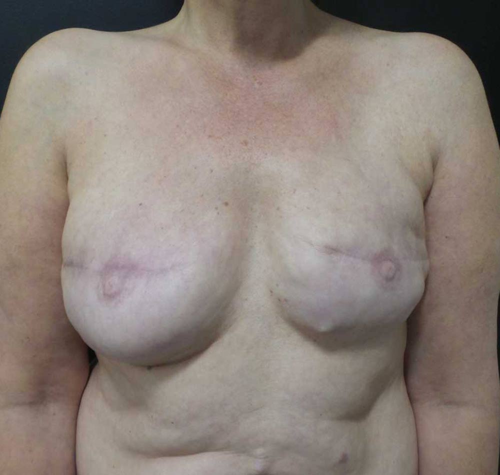 Diep Flaps After Previous Implants - Patient Before Treatment