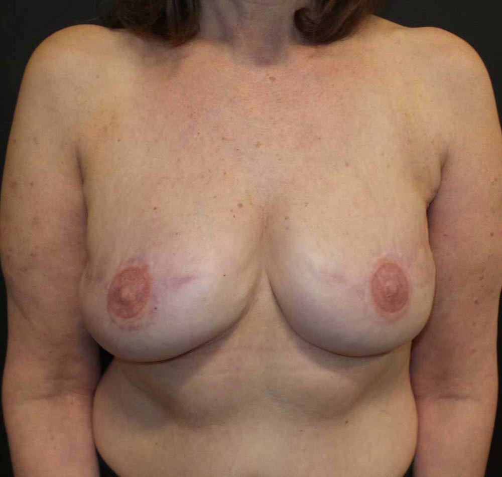 Diep Flaps After Previous Implants - Patient After Treatment