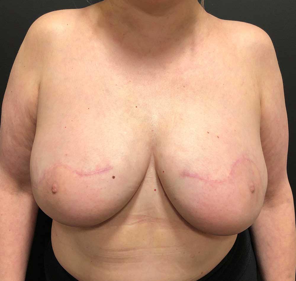 Diep Flaps After Previous Implants - Patient After Treatment