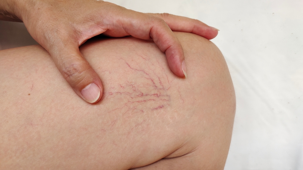 Say Goodbye to Spider Veins With Laser Vein Treatment