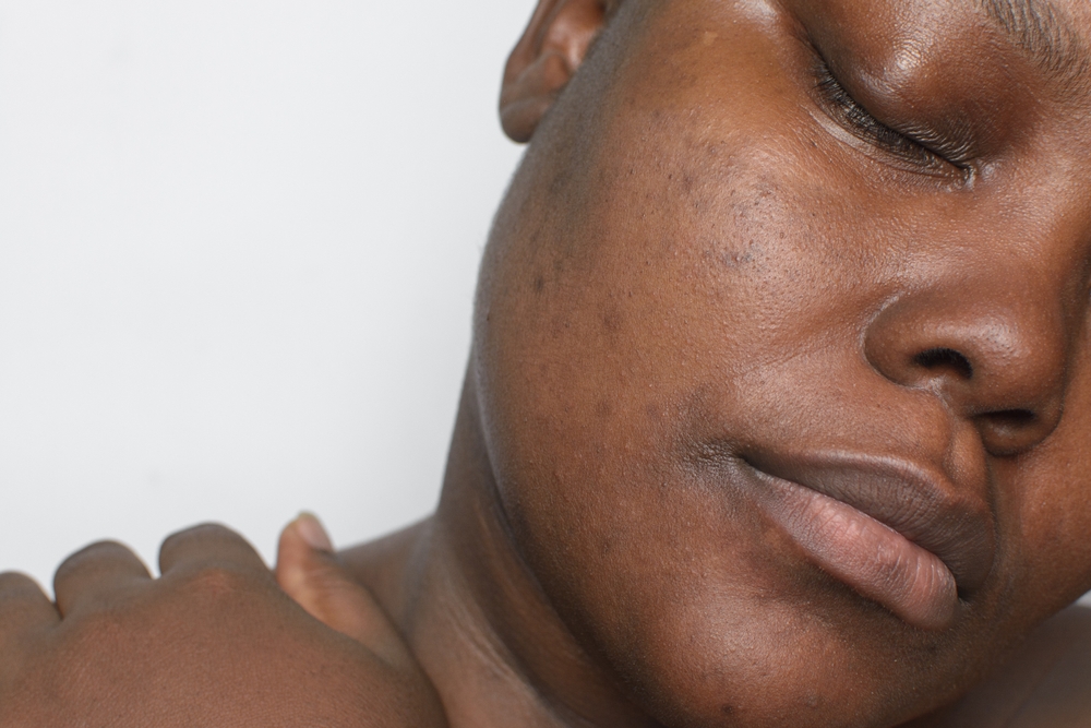 Understanding Hyperpigmentation and How To Treat It