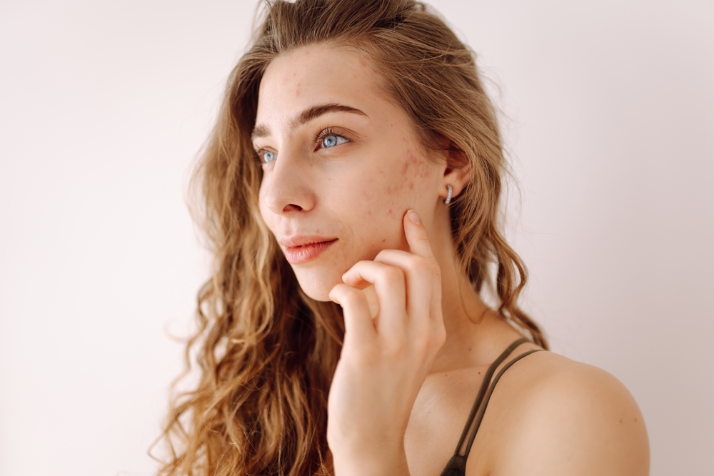 How AviClear Targets and Treats Persistent Acne for Long-Term Results