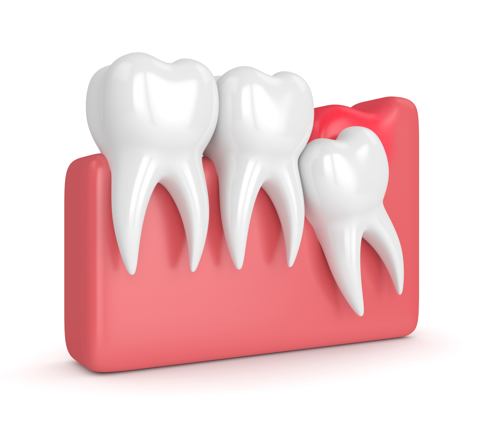 wisdom mesial impaction with pericoronitis