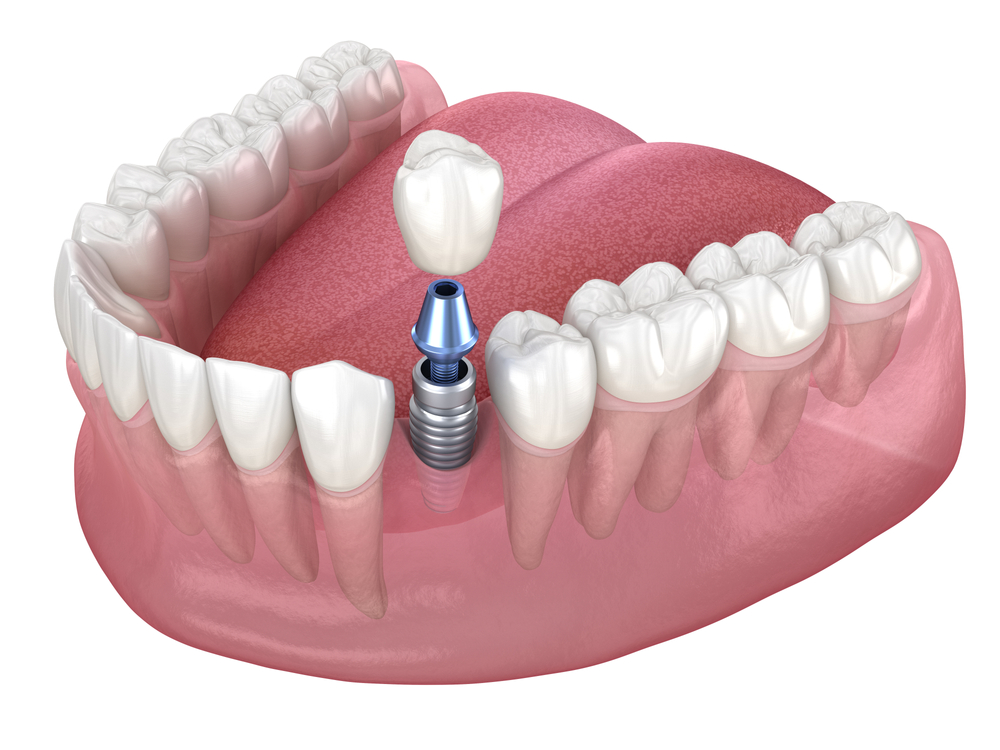 Premolar tooth recovery with implant