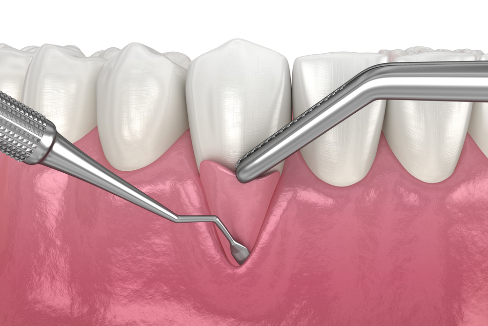 Soft tissue graft surgery. 3D illustration of Dental treatment