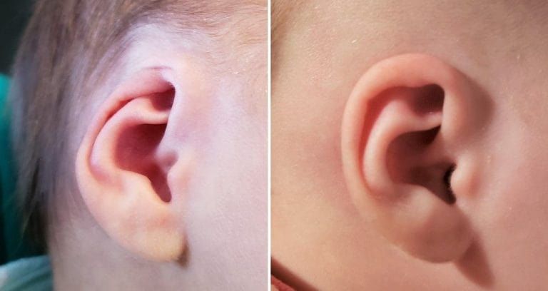 1 original cryptotia ear deformity correction