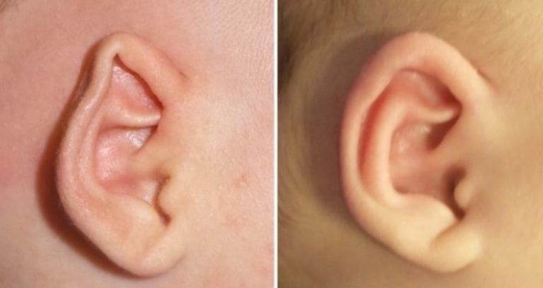 2 original cryptotia ear deformity correction