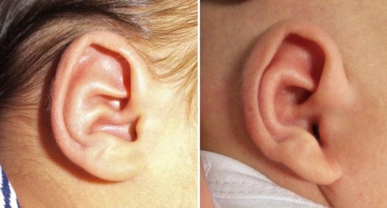 3 original_conchal_crus_ear_deformity_correction