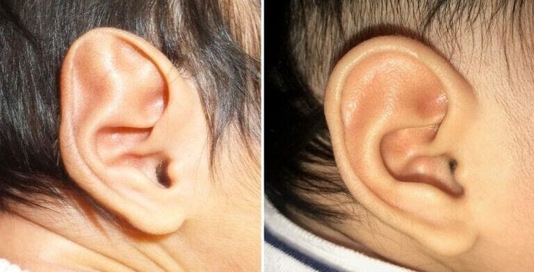 4 original_Stahls_ear_deformity