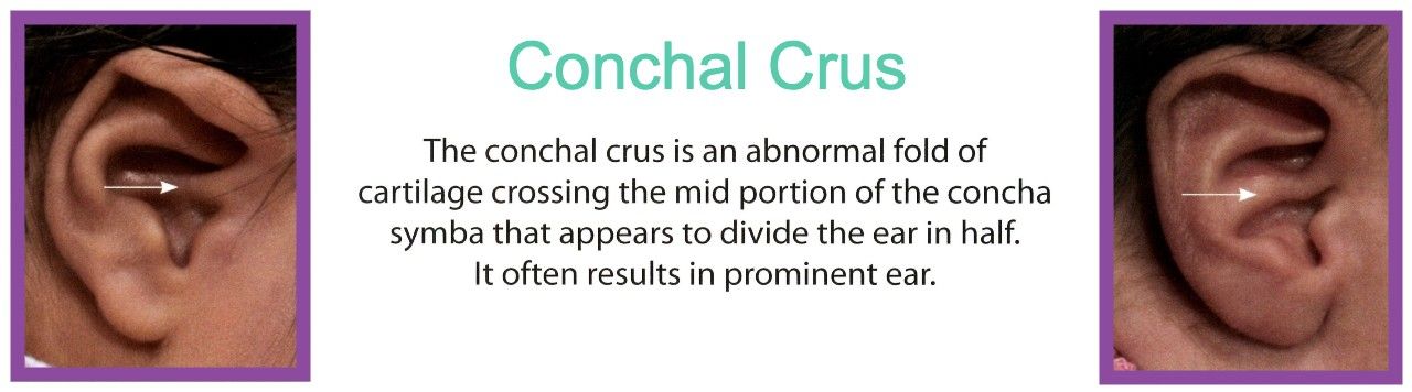 Conchal Crus