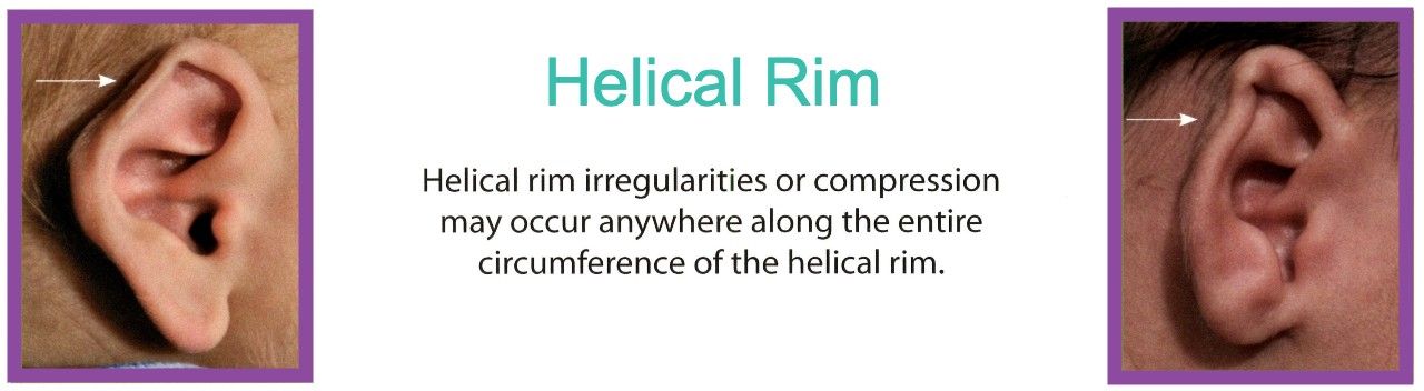 Helical Rim