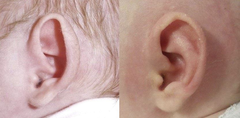 Prominent Ear treatment case
