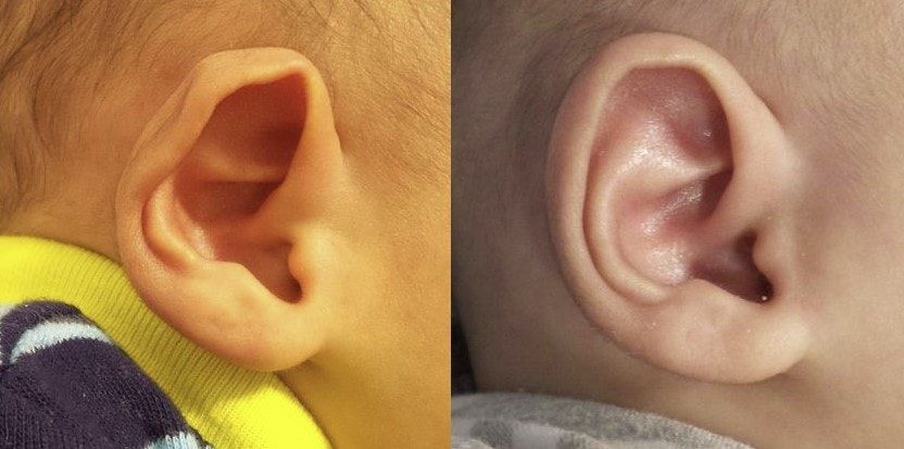 Prominent Ear treatment case