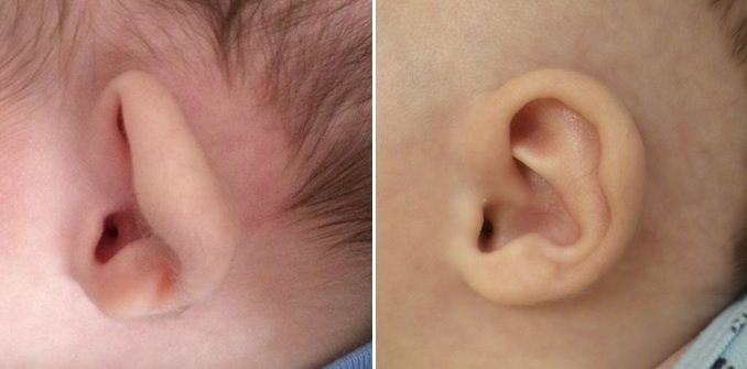 Prominent Ear treatment case