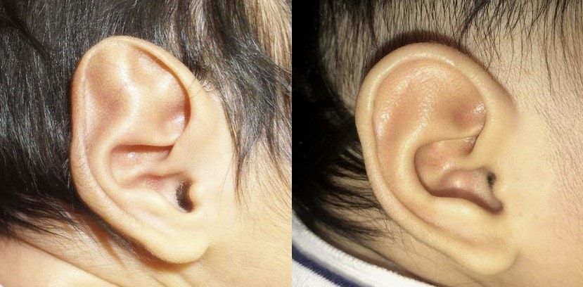 Stahl’s Ear Correction