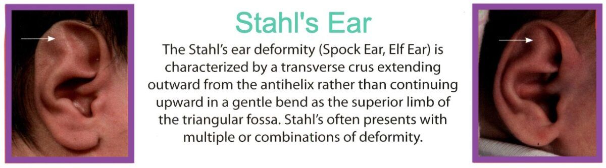 Stahl’s Ear Correction | NYC and Trumbull, CT | Ears R Us