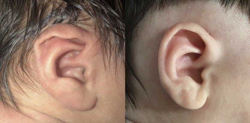 Ear lidding case after treatment