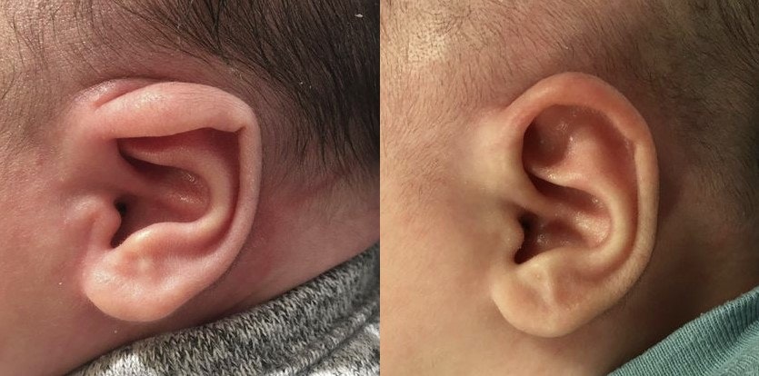 Ear lidding case after treatment