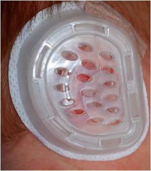 Prominent Ear Correction