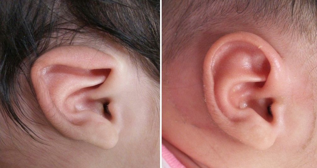 Ear_Lidding_after_Ear_Molding