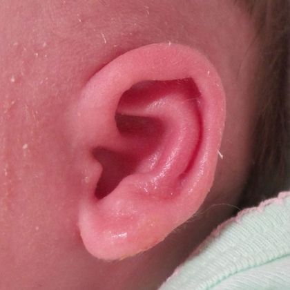 cup ear deformity after treatment