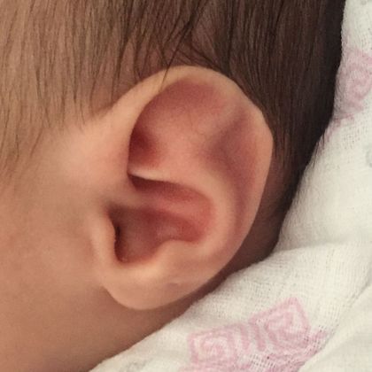 abnormal ear cartilage