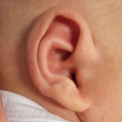 Prominent extra fold of cartilage in the middle of the ear after treatment