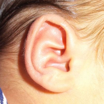 prominent extra fold of cartilage in the middle of the ear before treatment